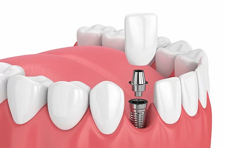 IMG-dental-implant-GettyImages-931130140