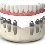 allon-8-2 (1)_webp